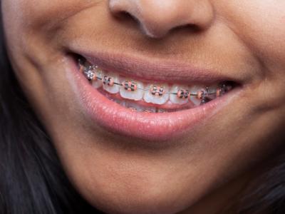 Imagem mostra mulher que sorri com aparelho de dentes